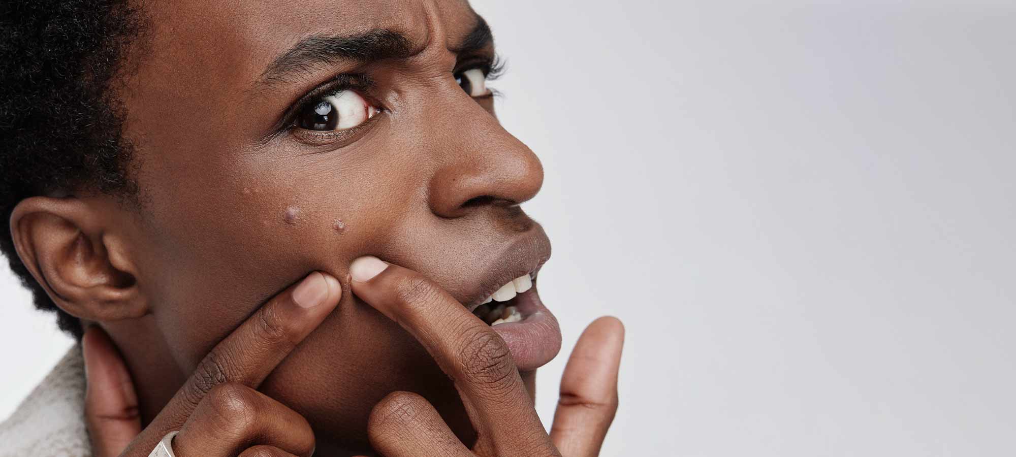 Πώς να αντιμετωπίσω τα μαύρα στίγματα στο πρόσωπο; 