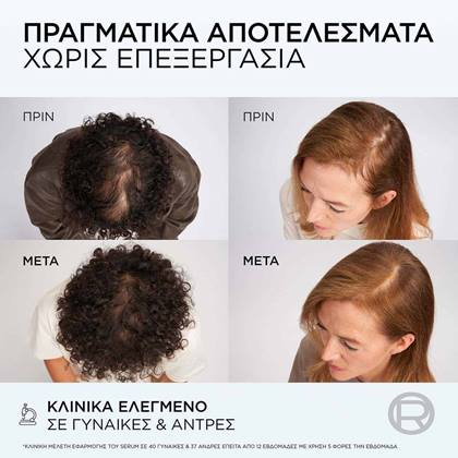Growth Booster Conditioner για Τριχόπτωση Πριν & Μετά