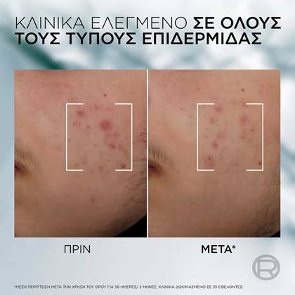 Derma Control Ορός Προσώπου Πριν & Μετά