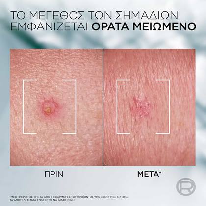 Derma Control Pimple Paste πριν & μετά