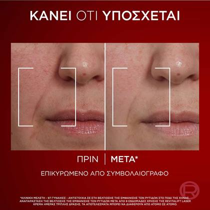 Laser Κρέμα Ημέρας Τριπλής Δράσης Πριν & Μετά